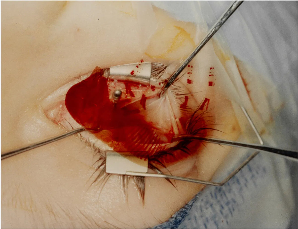 Untitled "Eye Surgery"