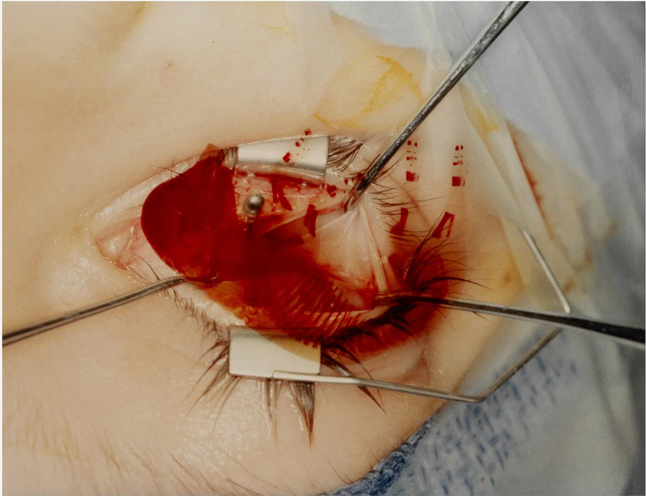 Untitled "Eye Surgery"